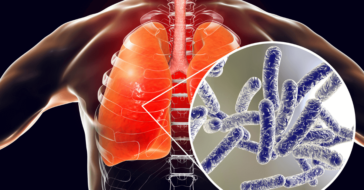 The image shows the human body's lungs with Legionella disease